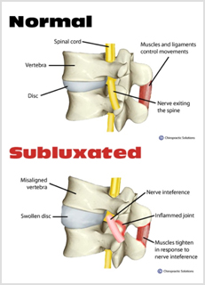 Spinal Subluxation