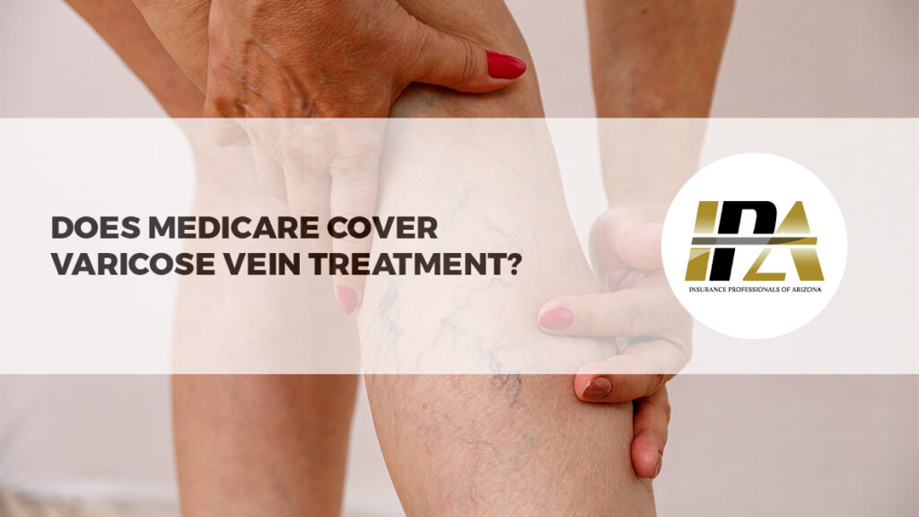 Does Medicare cover Varicose Vein treatment?