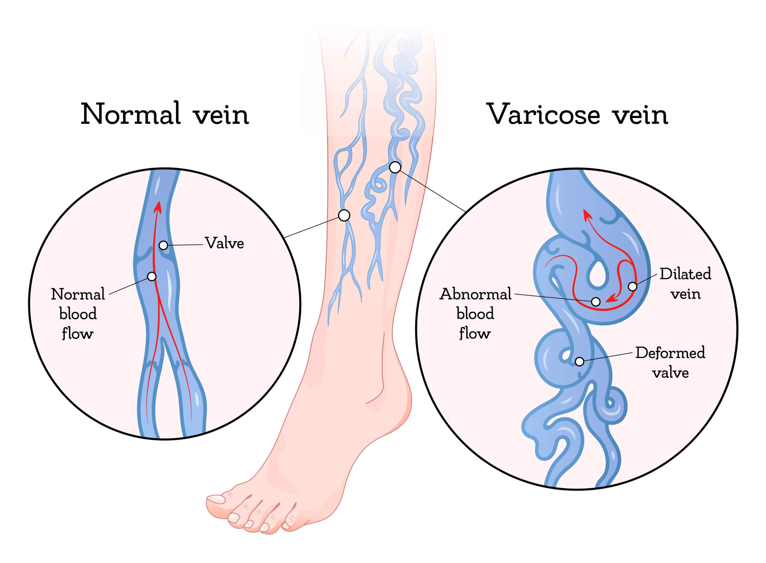 Varicose Vein 1